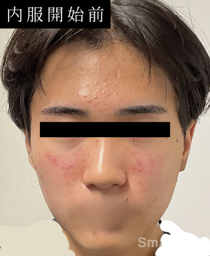 Commander isotretinoin