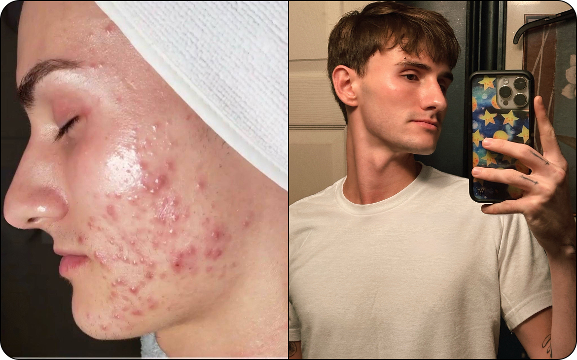 Commander roaccutane en ligne