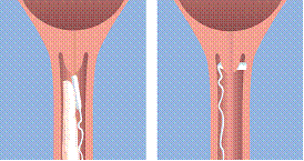 comment acheter misoprostol en ligne