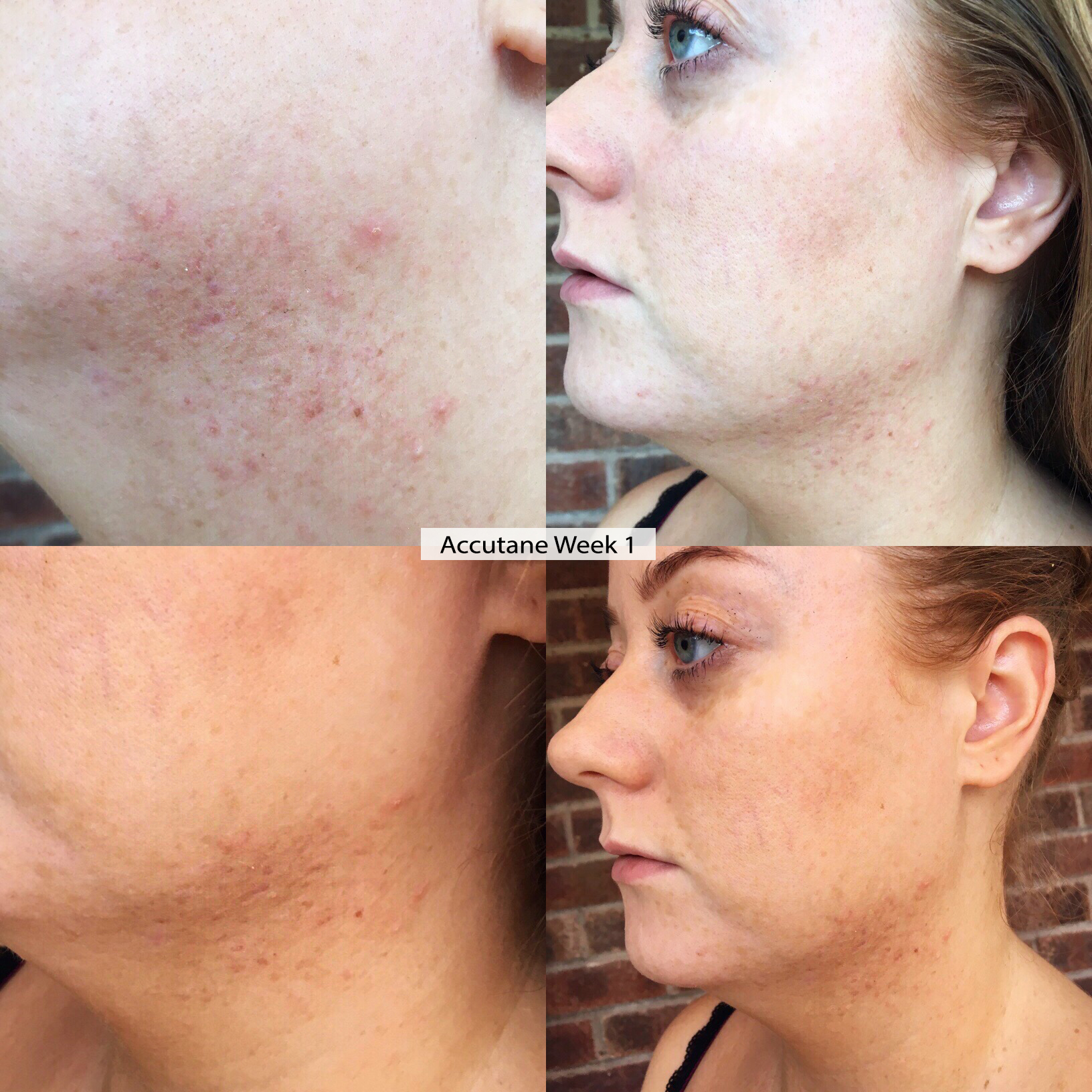Coût Accutane