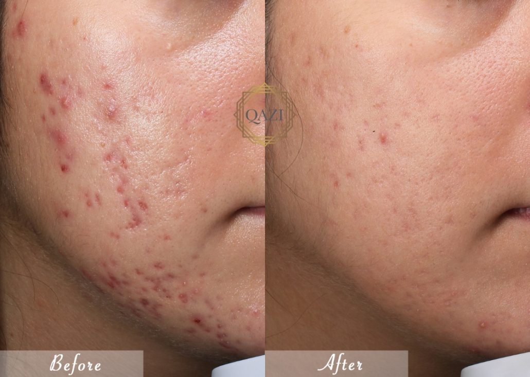 Coût du accutane