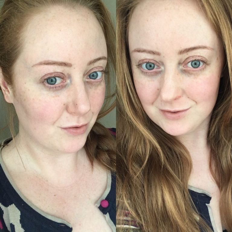 Coût du accutane