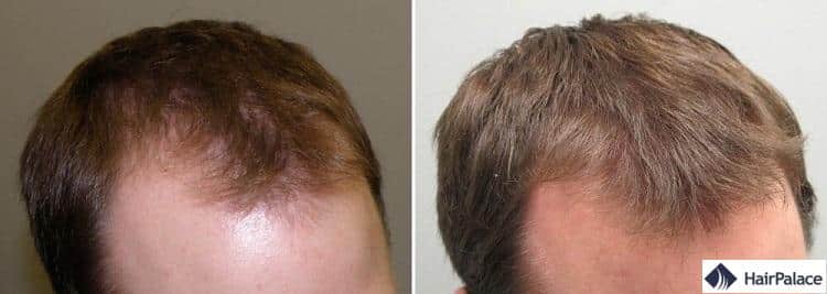 Coût du finasteride