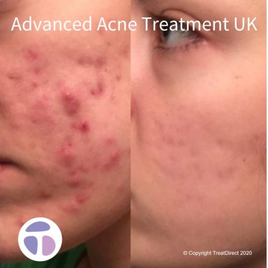 Coût isotretinoin