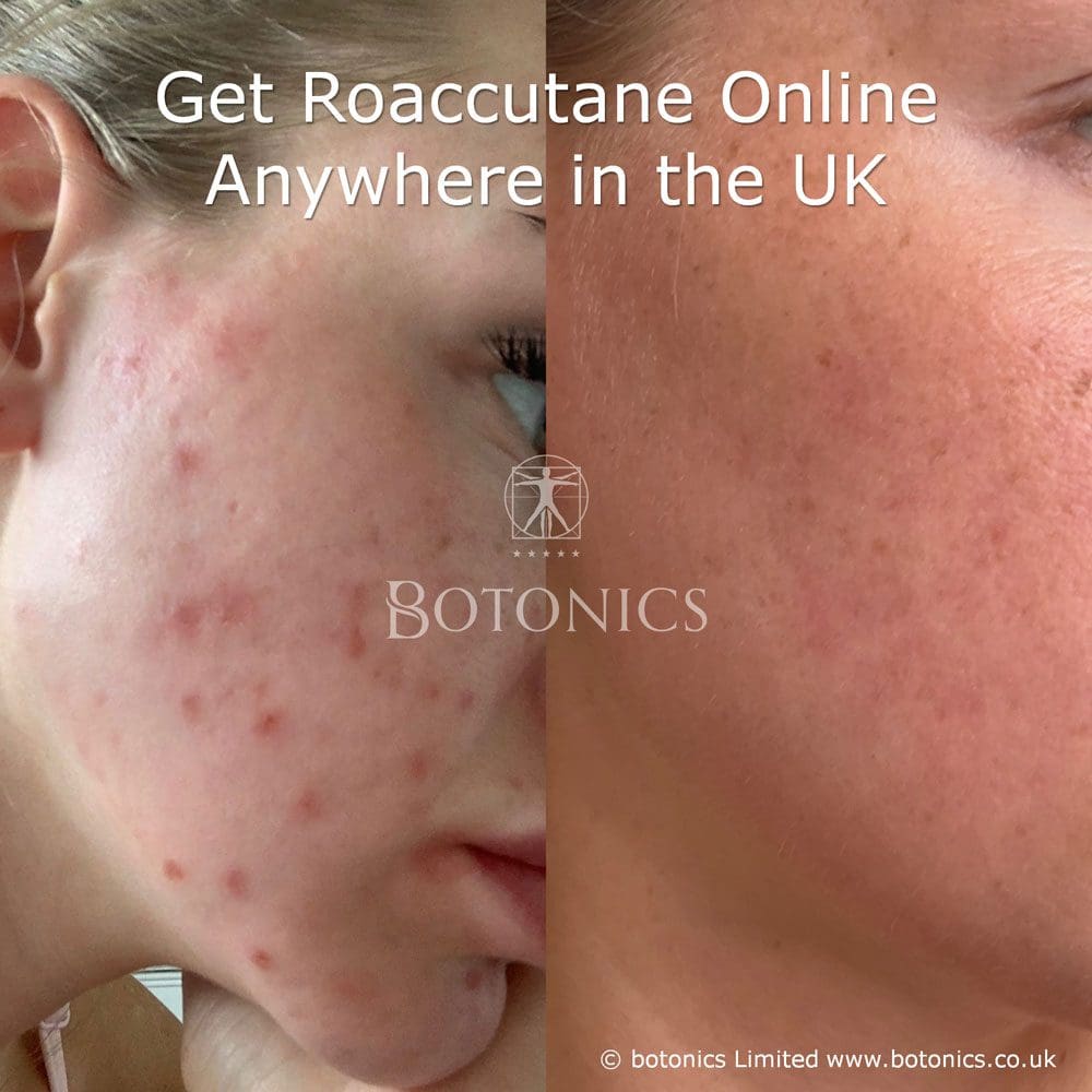 Coût roaccutane