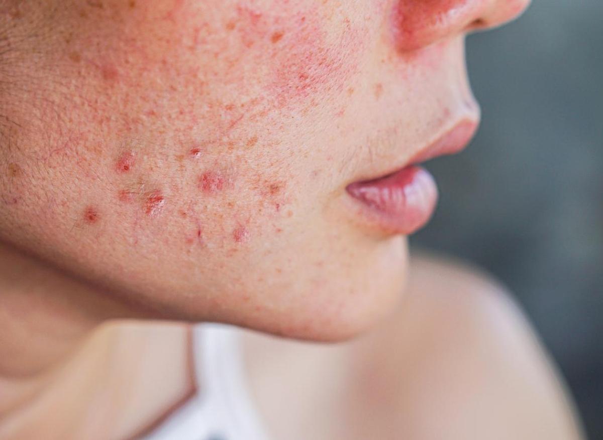 Coût Roaccutane