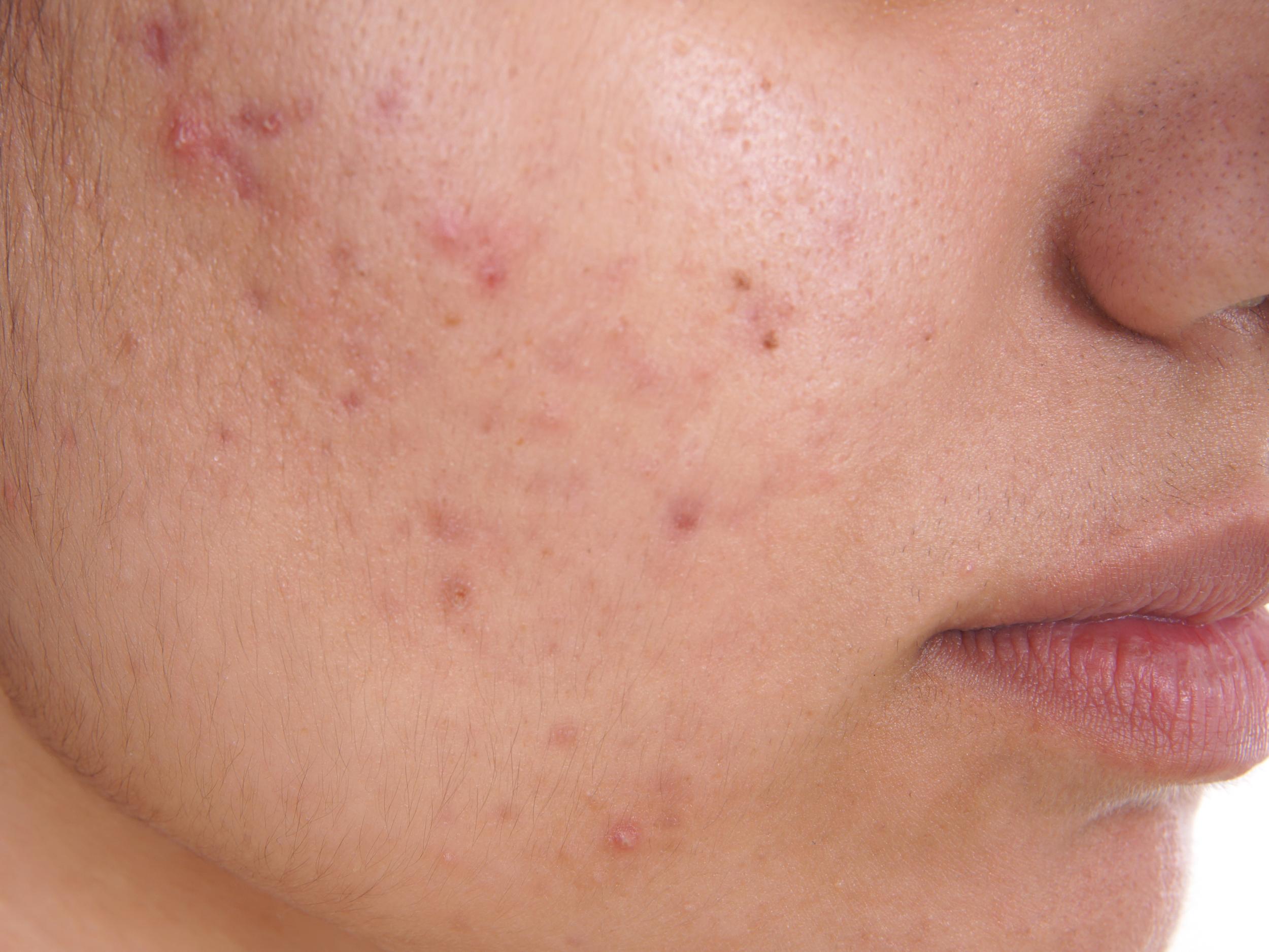 Roaccutane de 10 mg
