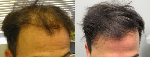 Propecia Cheveux Prix