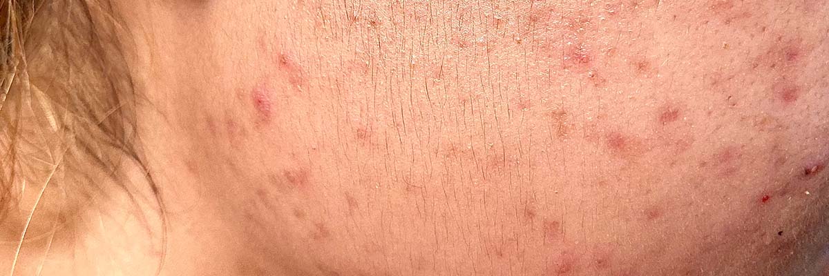 Accutane moins cher