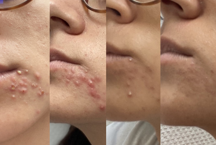 Pilule sous roaccutane