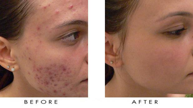 Online Dermatologist Accutane