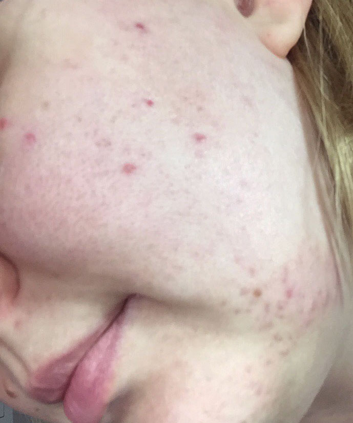 isotretinoin 40mg