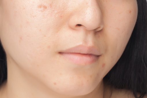 Prix pour roaccutane