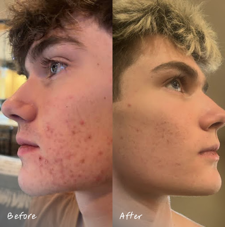 Doxycycline acne online