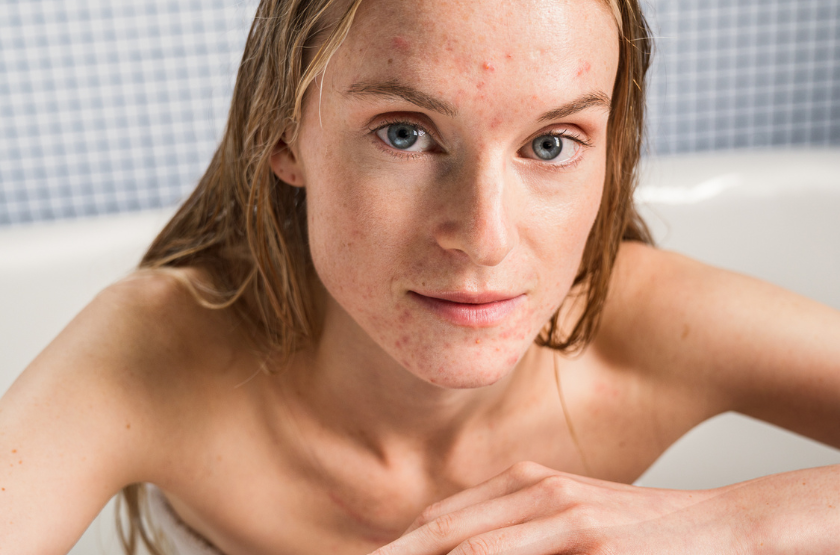 Roaccutane Sans Pillule