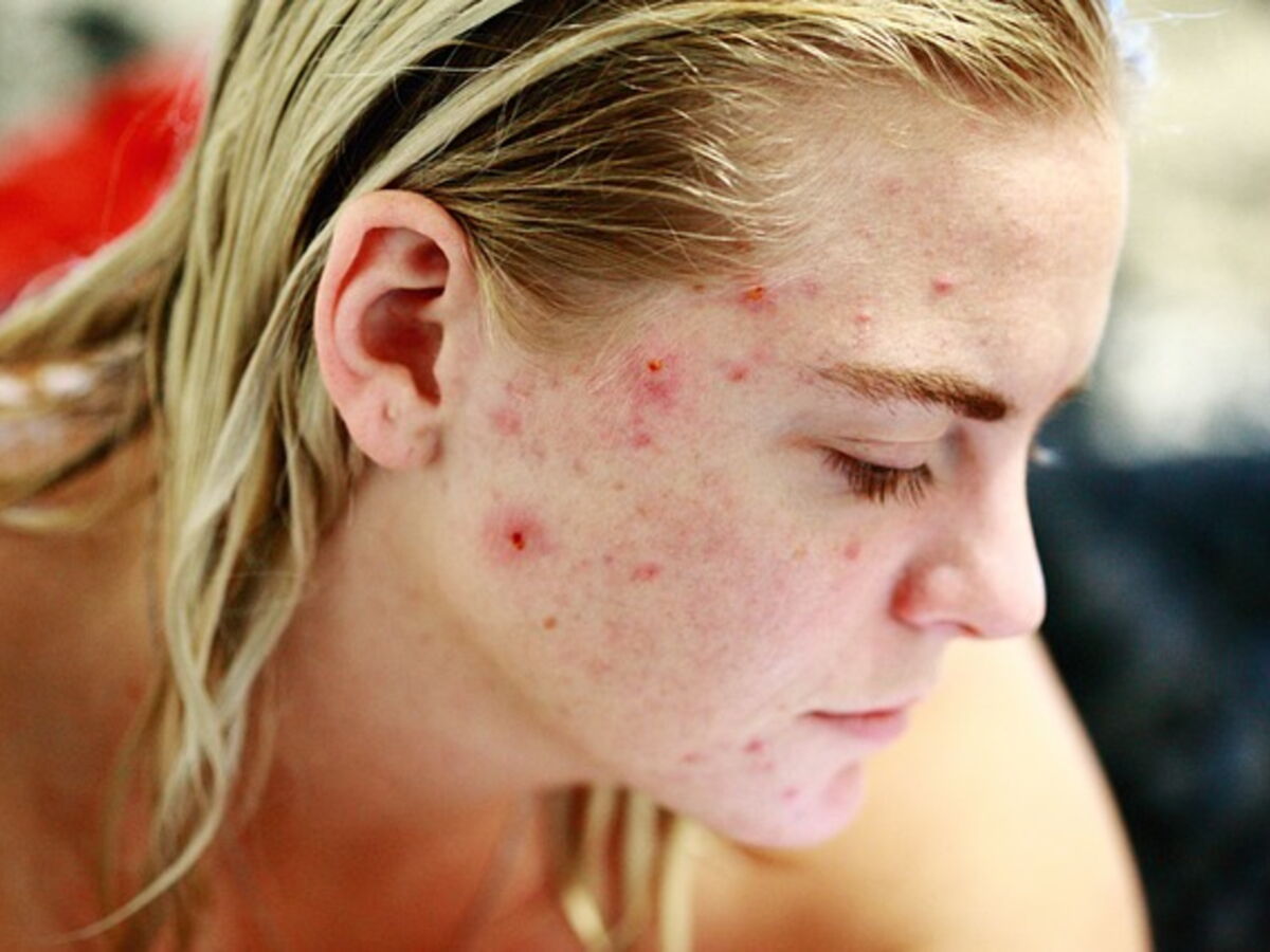 Roaccutane 10mg