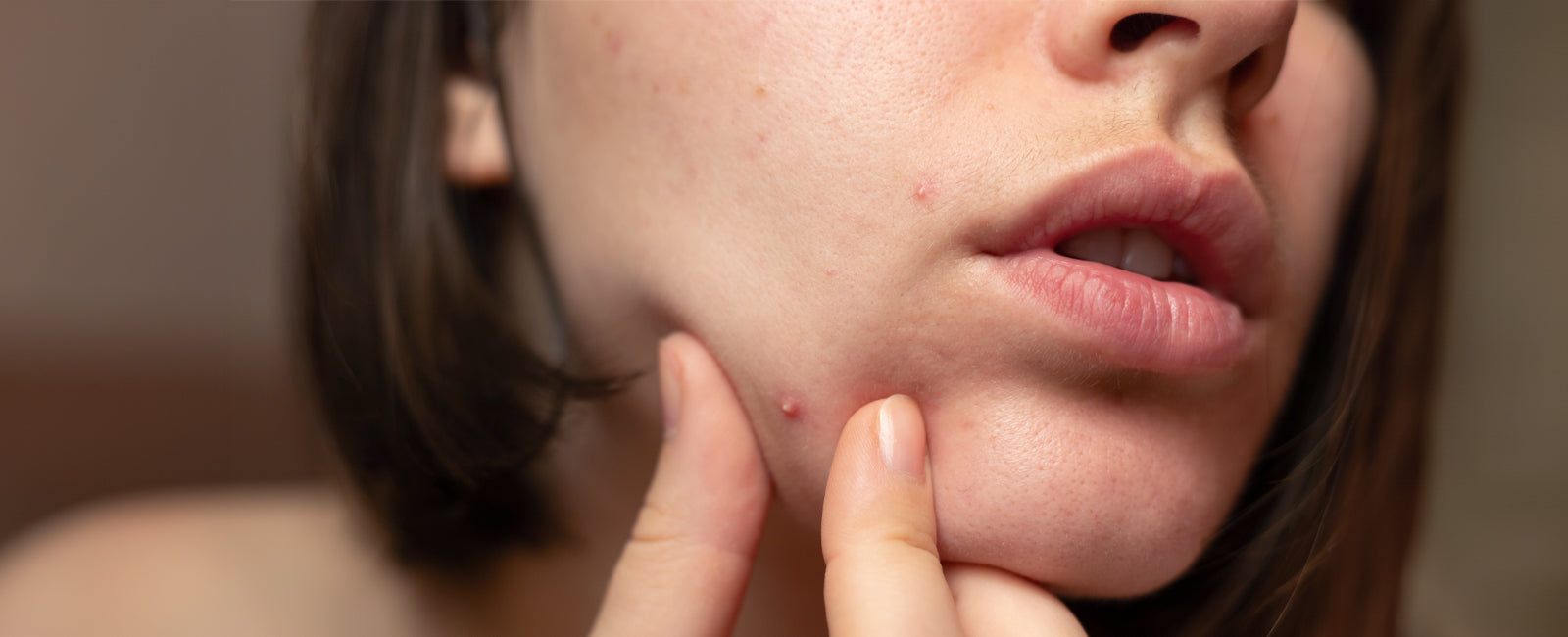 Pilule de roaccutane