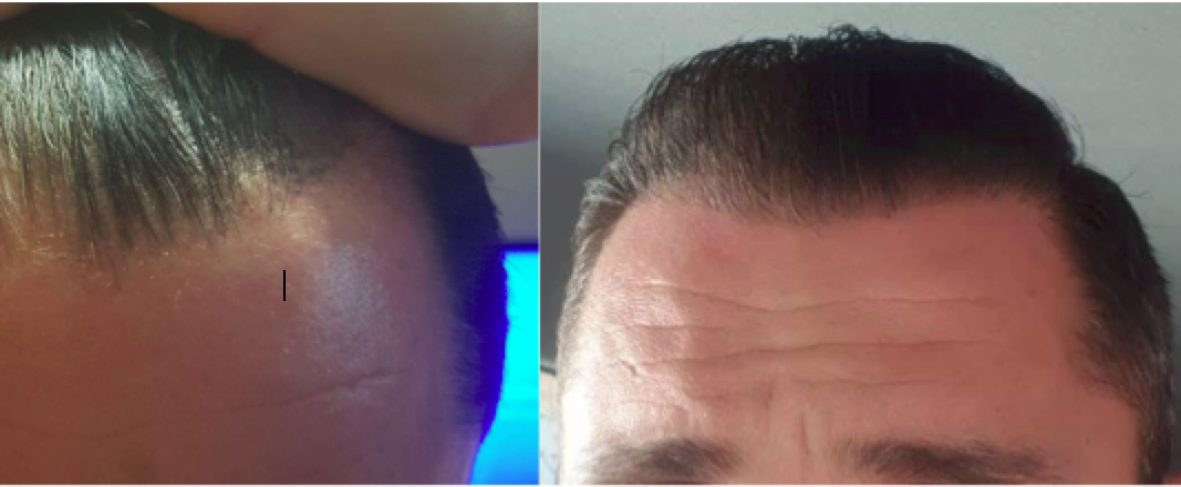 Finasteride en ligne