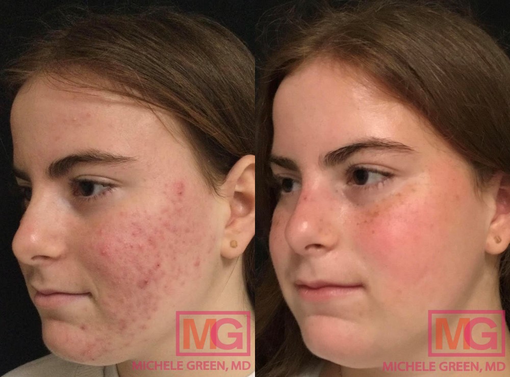 roaccutane pharmacie online