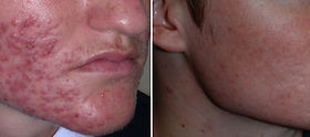 Roaccutane Ou Acheter