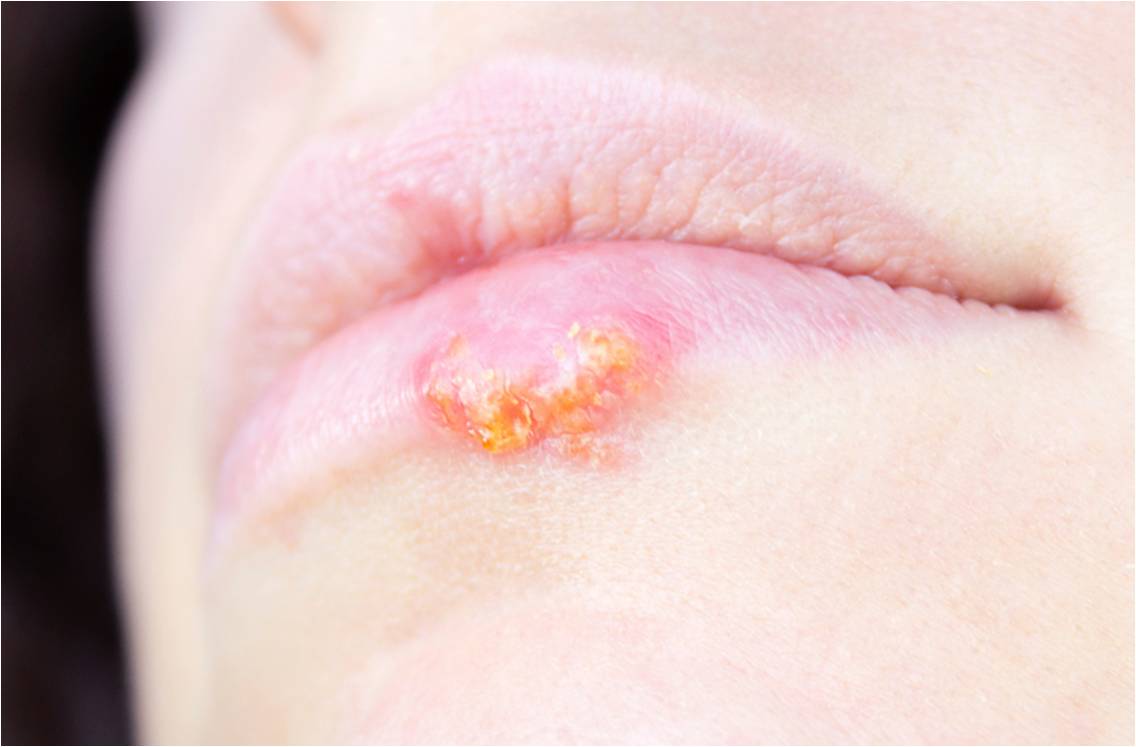 Zovirax 200mg