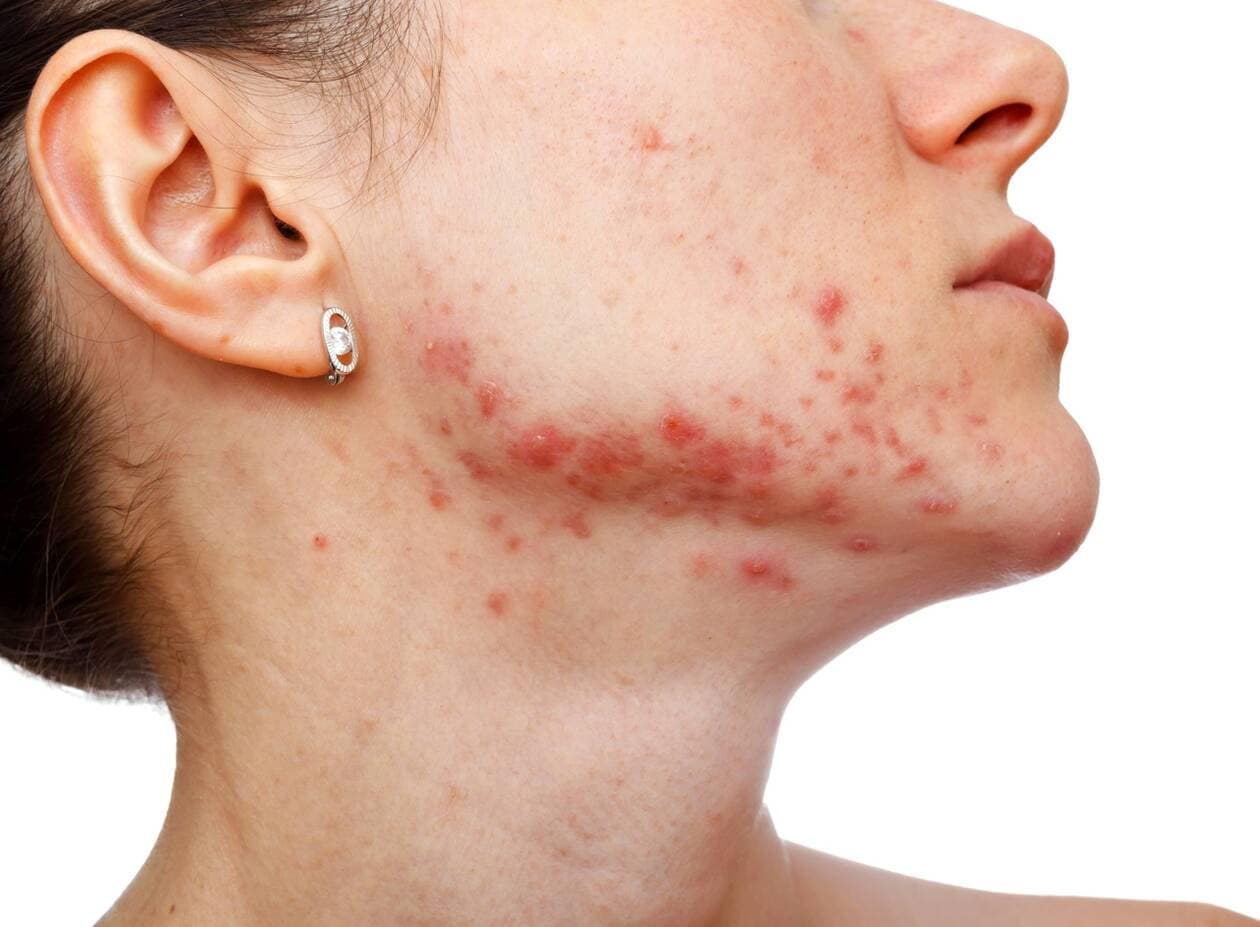 Roaccutane vente en ligne