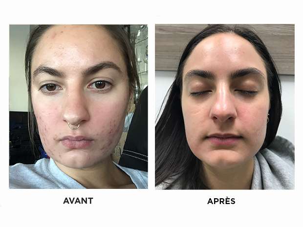 Roaccutane Acheter En Ligne