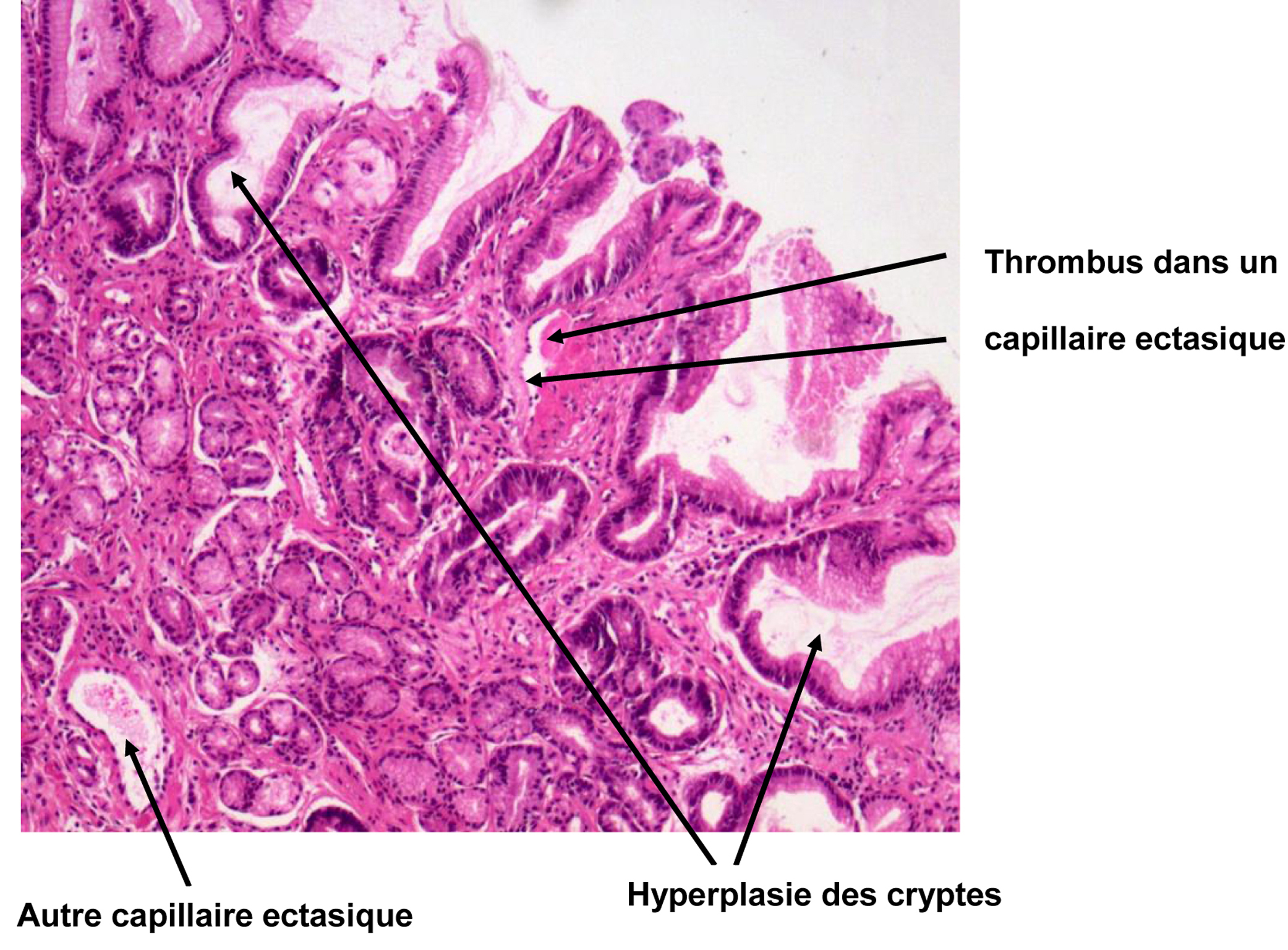 Fluconazole moins cher