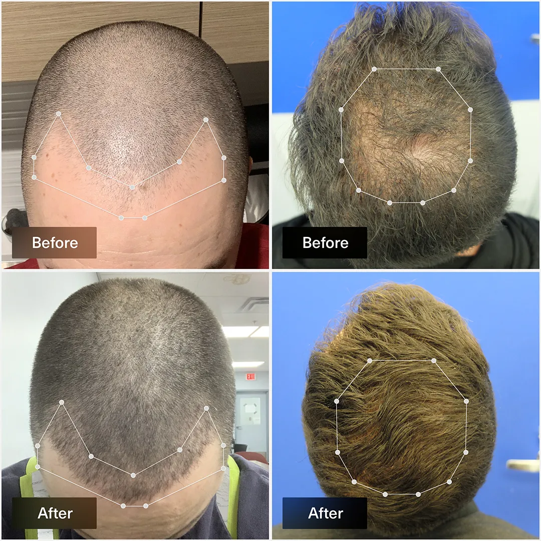 Finasteride acheter en ligne