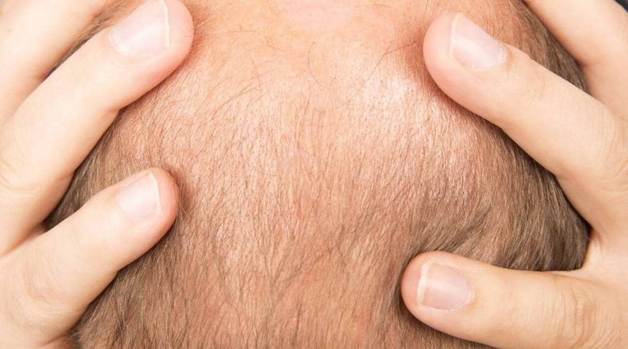 Finasteride france