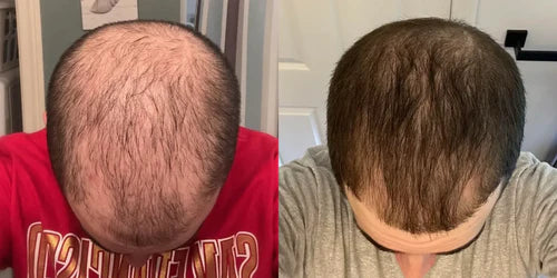 Finasteride Gel Online