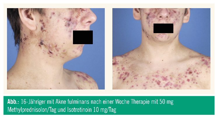 Isotretinoin 10mg online