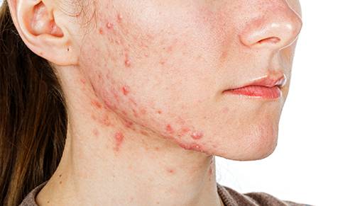 Isotretinoin comment acheter