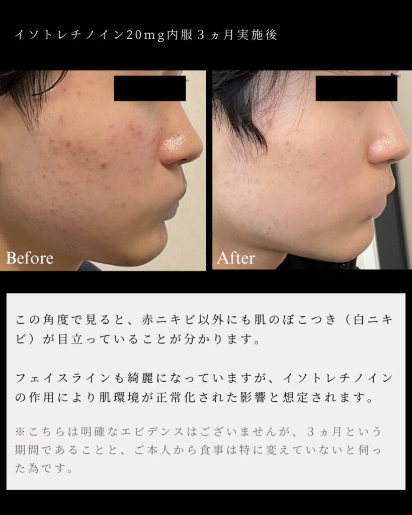 Isotretinoin sans ordonnance