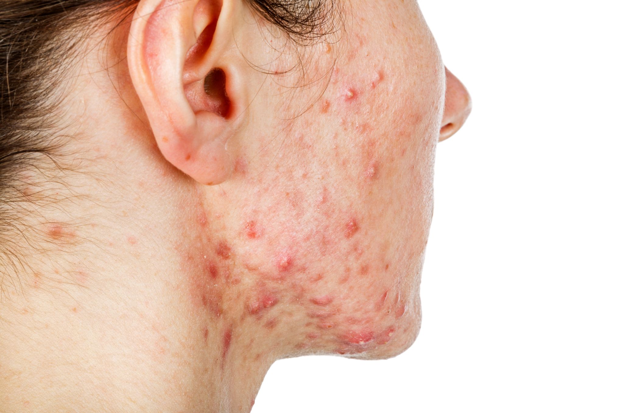 Isotrétinoïne achat france