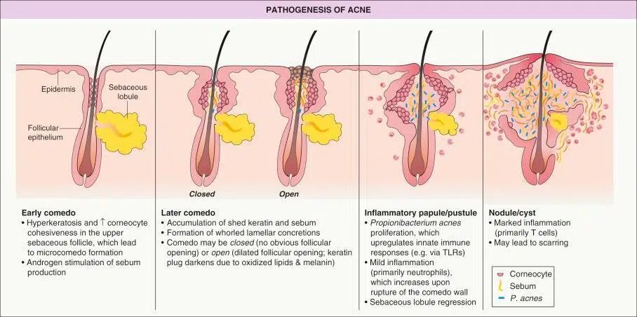 isotrétinoïne en ligne