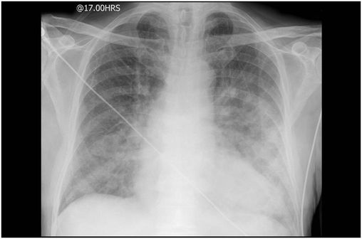 Lasilix Sans Ordonnance