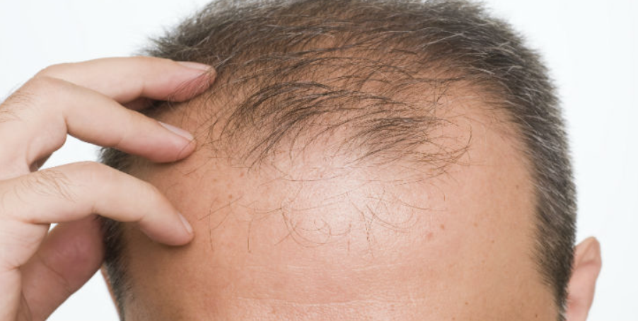 Le prix finasteride