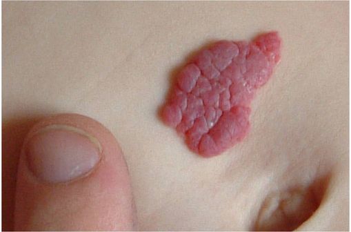 Le propranolol sans ordonnance