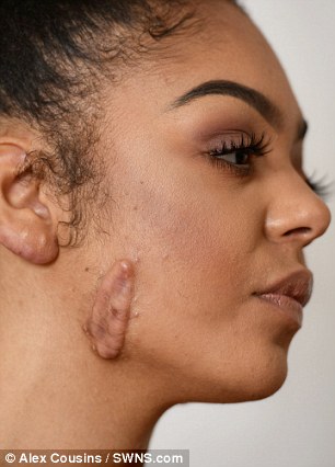 Online dermatologist accutane