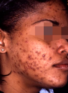 Online Dermatologist Accutane