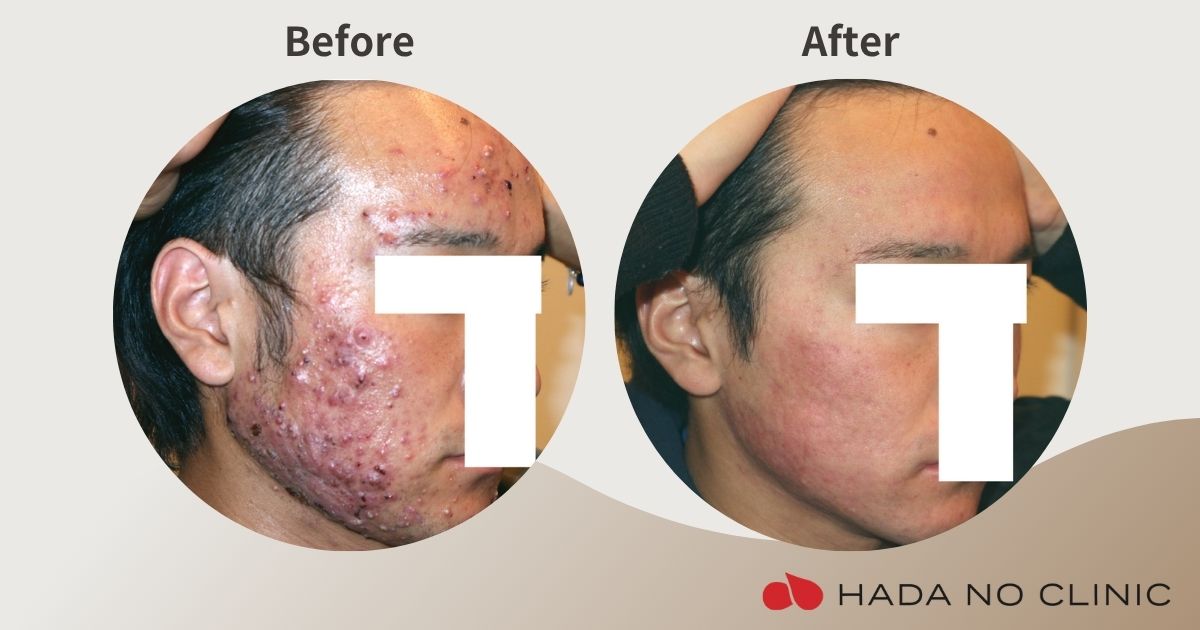 Online dermatologist accutane