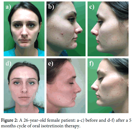 Online dermatologist isotretinoin
