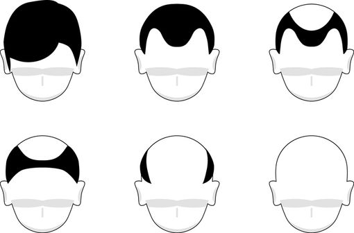 Ou Acheter Finasteride