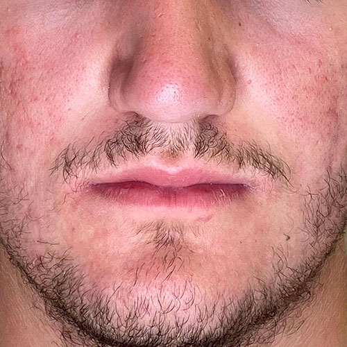 Pilule apres roaccutane