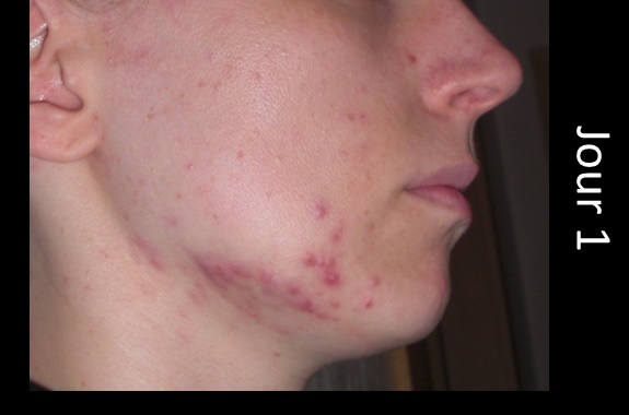 Pilule Optilova Roaccutane