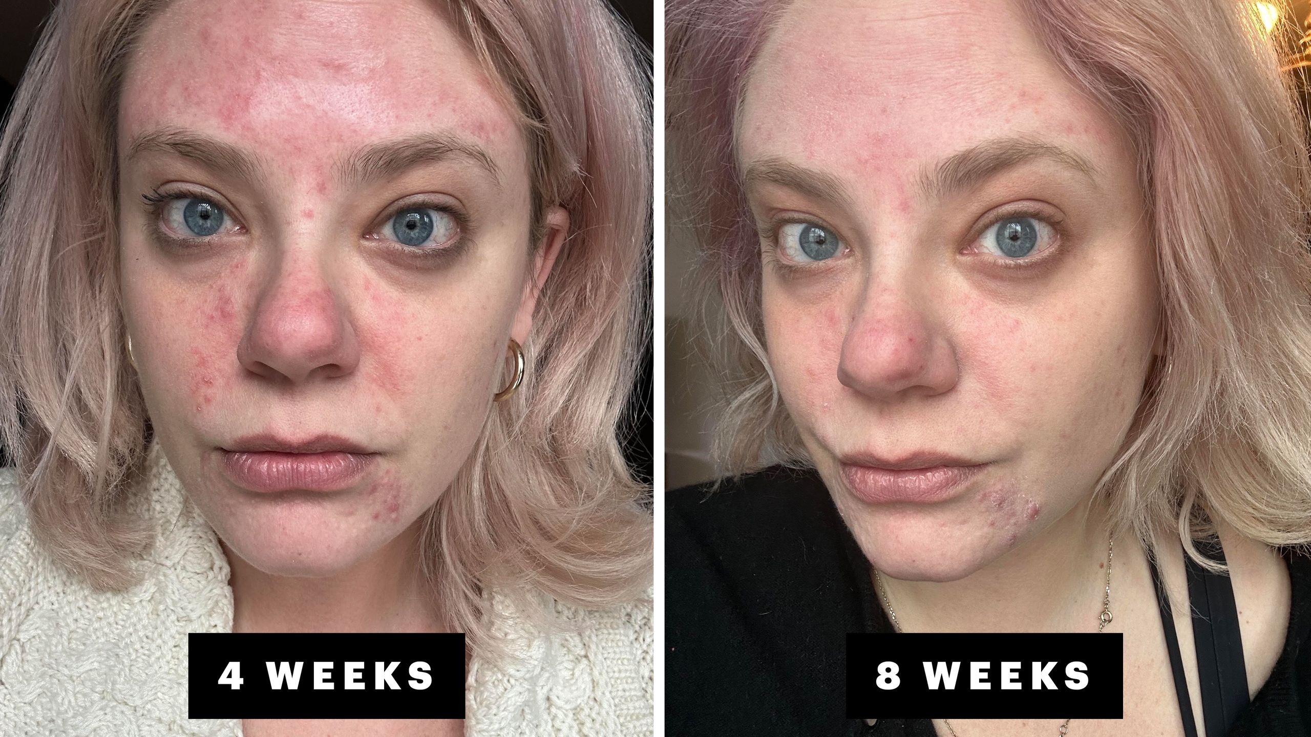 Prix Accutane