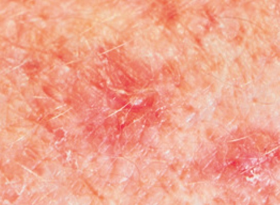 Prix aldara creme