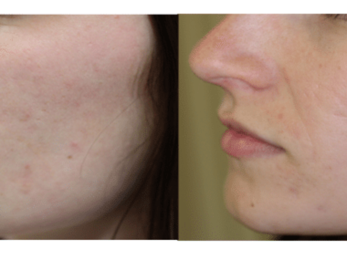 Prix Du Isotretinoin