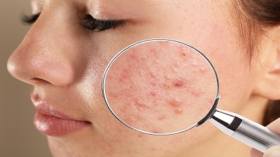 Prix Du Traitement Roaccutane